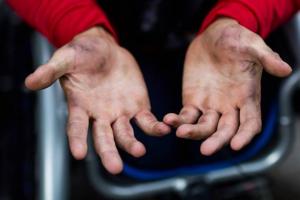 Ryan Chalmers' hands